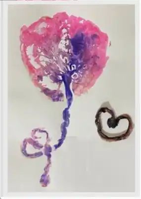 Impresión de placenta con el cordón umbilical en forma de corazón